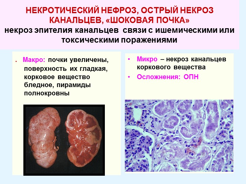 НЕКРОТИЧЕСКИЙ НЕФРОЗ, ОСТРЫЙ НЕКРОЗ КАНАЛЬЦЕВ, «ШОКОВАЯ ПОЧКА»   некроз эпителия канальцев  связи